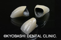 メタルボンドクラウン