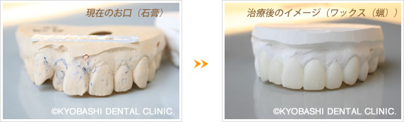 ワックスアップ