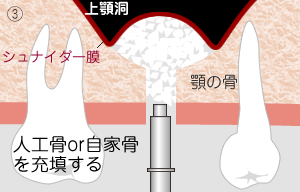 人工骨を入れる