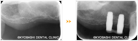 ソケットリフト