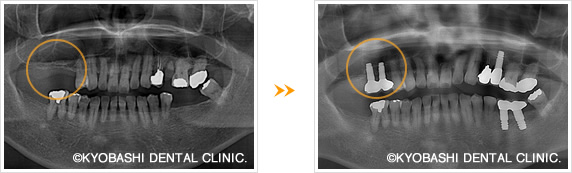 奥歯のインプラントレントゲン