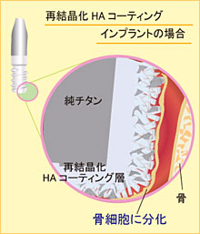 再結晶化HAコーティング