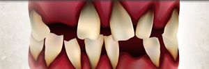 歯がボロボロ フルマウス 全顎治療